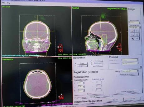 放疗做膜是什么意思精准放疗！八步读懂放疗流程_https://www.jmylbn.com_新闻资讯_第15张