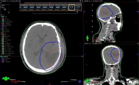 放疗做膜是什么意思精准放疗！八步读懂放疗流程_https://www.jmylbn.com_新闻资讯_第11张