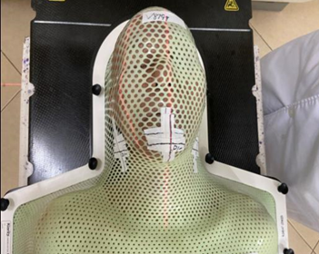 放疗做膜是什么意思精准放疗！八步读懂放疗流程_https://www.jmylbn.com_新闻资讯_第6张