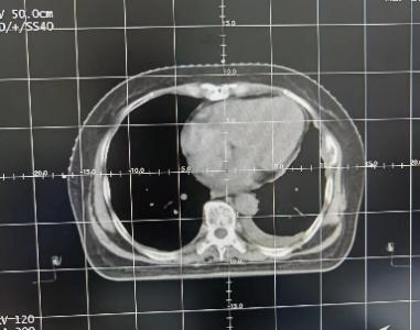 放疗做膜是什么意思精准放疗！八步读懂放疗流程_https://www.jmylbn.com_新闻资讯_第14张