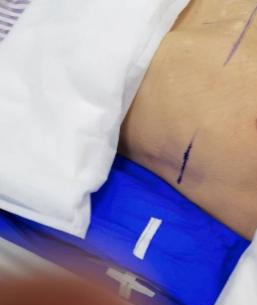 放疗做膜是什么意思精准放疗！八步读懂放疗流程_https://www.jmylbn.com_新闻资讯_第9张