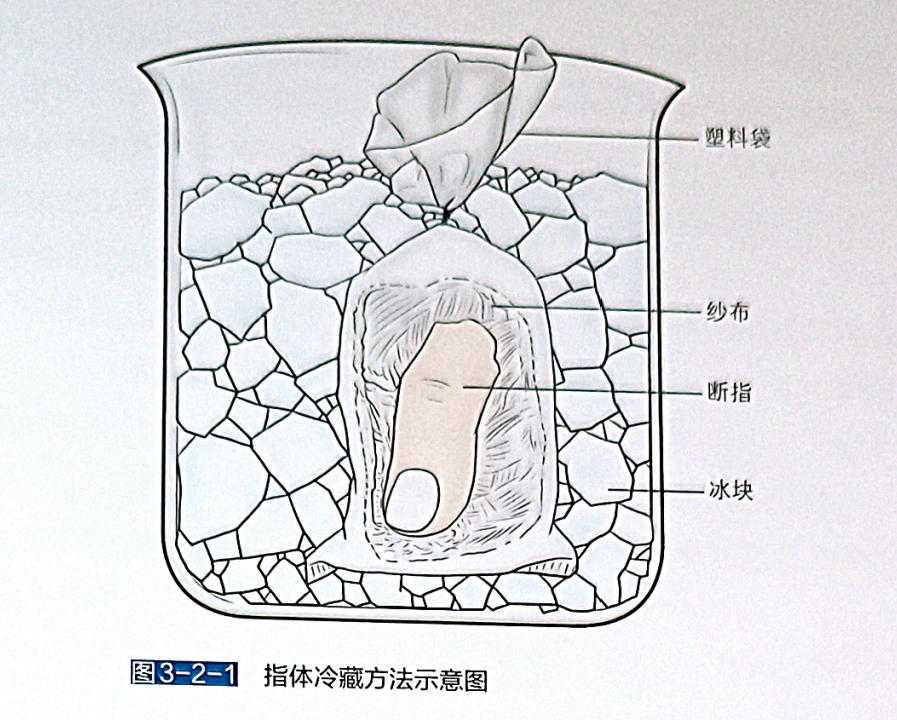 怎么区分显微剪刀揪心 ｜ 他才2岁多，竟敢用剪刀剪断小拇指！_https://www.jmylbn.com_新闻资讯_第13张