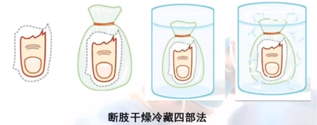 怎么区分显微剪刀揪心 ｜ 他才2岁多，竟敢用剪刀剪断小拇指！_https://www.jmylbn.com_新闻资讯_第12张