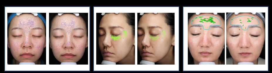 多极射频是什么国产射频美容仪，真的靠谱吗？_https://www.jmylbn.com_新闻资讯_第18张