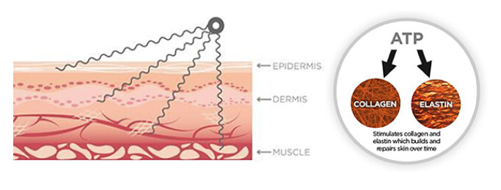 多极射频是什么国产射频美容仪，真的靠谱吗？_https://www.jmylbn.com_新闻资讯_第17张