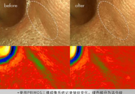 多极射频是什么国产射频美容仪，真的靠谱吗？_https://www.jmylbn.com_新闻资讯_第19张