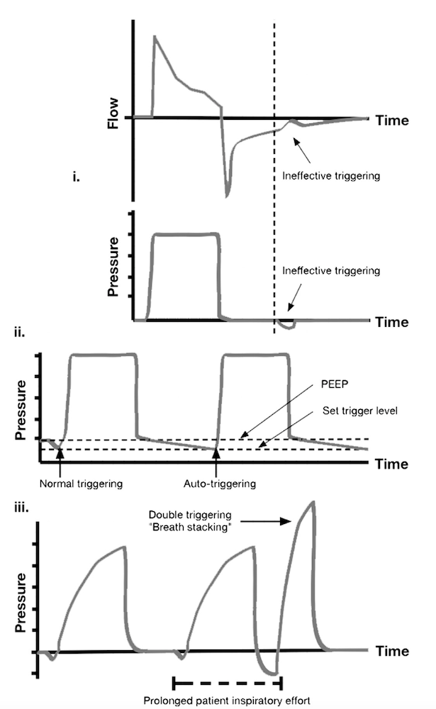 为什么成人呼吸机用容控呼吸机波形（Ventilator Waveforms 译文）_https://www.jmylbn.com_新闻资讯_第26张