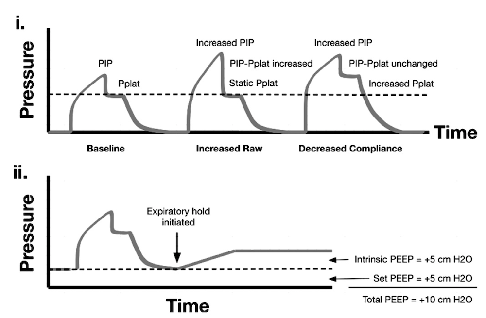 为什么成人呼吸机用容控呼吸机波形（Ventilator Waveforms 译文）_https://www.jmylbn.com_新闻资讯_第10张