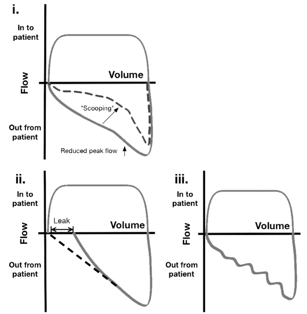 为什么成人呼吸机用容控呼吸机波形（Ventilator Waveforms 译文）_https://www.jmylbn.com_新闻资讯_第24张