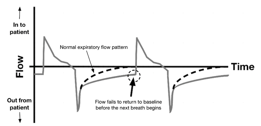 为什么成人呼吸机用容控呼吸机波形（Ventilator Waveforms 译文）_https://www.jmylbn.com_新闻资讯_第14张