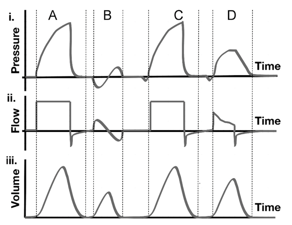 为什么成人呼吸机用容控呼吸机波形（Ventilator Waveforms 译文）_https://www.jmylbn.com_新闻资讯_第7张