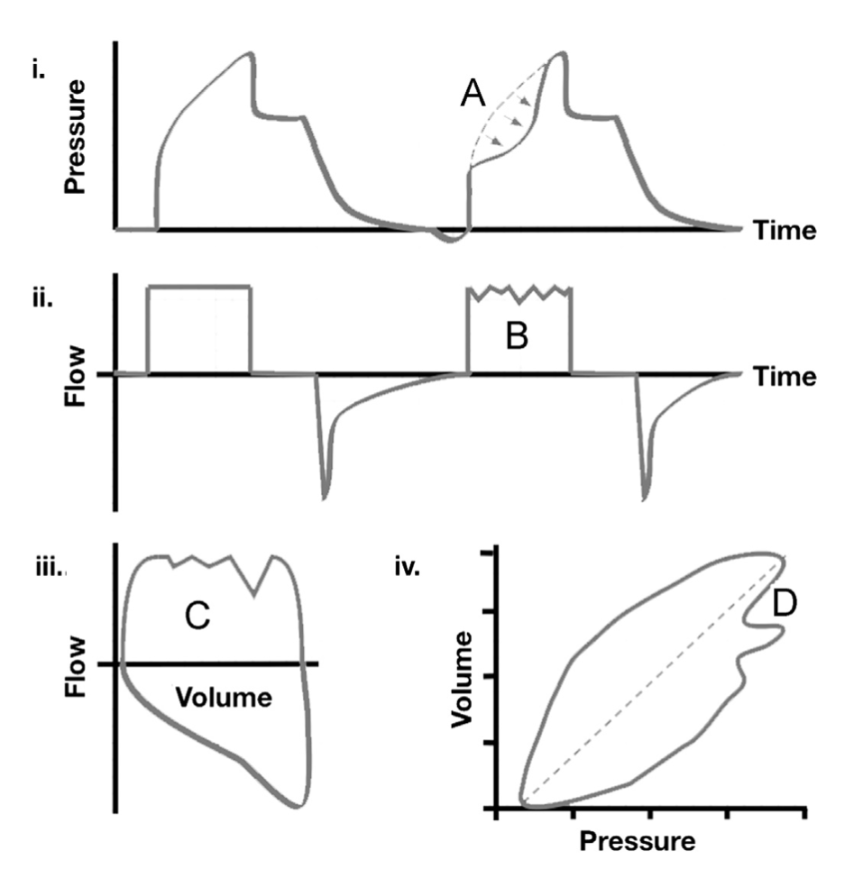 为什么成人呼吸机用容控呼吸机波形（Ventilator Waveforms 译文）_https://www.jmylbn.com_新闻资讯_第28张