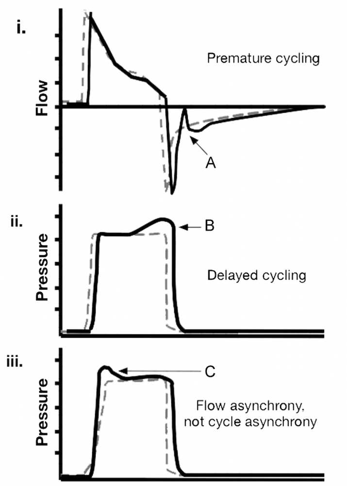 为什么成人呼吸机用容控呼吸机波形（Ventilator Waveforms 译文）_https://www.jmylbn.com_新闻资讯_第29张