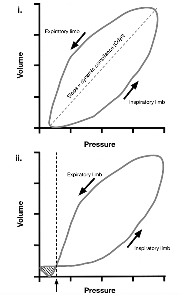 为什么成人呼吸机用容控呼吸机波形（Ventilator Waveforms 译文）_https://www.jmylbn.com_新闻资讯_第16张
