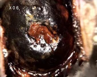 激光治疗仪能治什么病宫颈疾病患者的福音——仪征市中医院妇科成功引进二氧化碳激光治疗仪！_https://www.jmylbn.com_新闻资讯_第2张