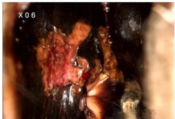 激光治疗仪能治什么病宫颈疾病患者的福音——仪征市中医院妇科成功引进二氧化碳激光治疗仪！_https://www.jmylbn.com_新闻资讯_第4张