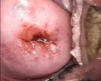 激光治疗仪能治什么病宫颈疾病患者的福音——仪征市中医院妇科成功引进二氧化碳激光治疗仪！_https://www.jmylbn.com_新闻资讯_第1张