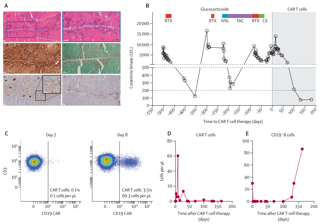 Georg Schett 教授团队使用CAR-T细胞疗法