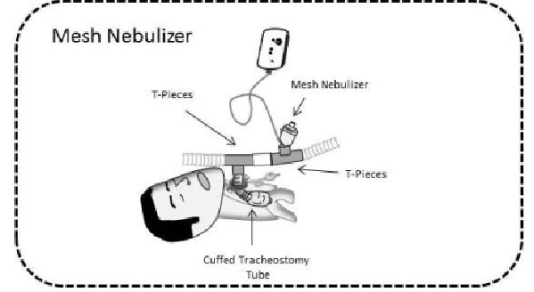 呼吸机雾化装置怎么用雾化器装置Nebulizer System——Aerogen  T型接头_https://www.jmylbn.com_新闻资讯_第7张