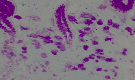 取病理什么意思病理报告为什么不能当天取？报告里的+-代表了什么？_https://www.jmylbn.com_新闻资讯_第6张