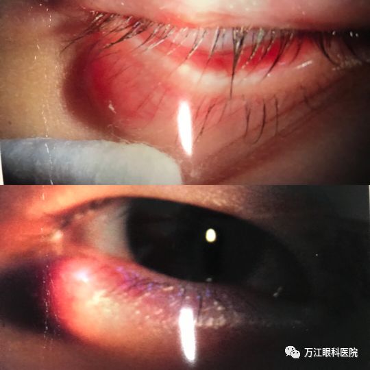 健康科普 儿童眼红肿 您有留意吗 绵阳万江眼科 微信公众号文章阅读 Wemp