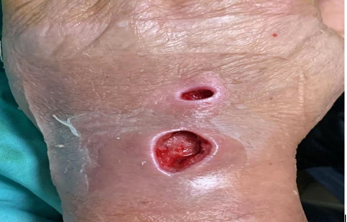 为什么输液要盖块纱布护士请警惕！输液留置针竟引发静脉血栓！？_https://www.jmylbn.com_新闻资讯_第5张