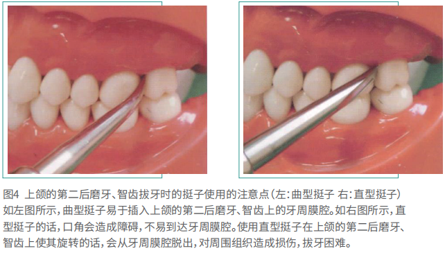 剥离子怎么使用拔牙的细致流程详解_新闻资讯_第3张_活检穿刺产品网 剥离子怎么使用拔牙的细致流程详解_https://www.jmylbn.com_新闻资讯_第3张
