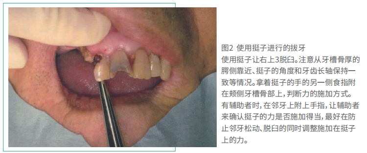 拔牙的细致流程详解