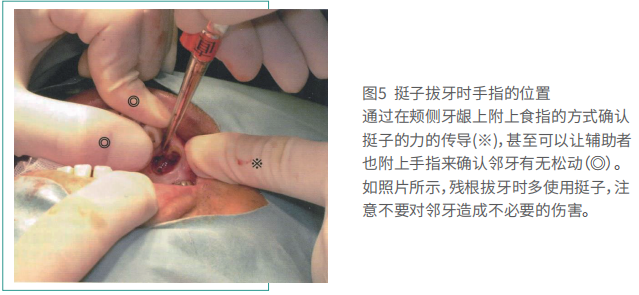 拔牙的细致流程详解