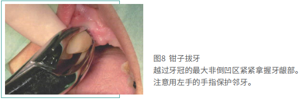 拔牙的细致流程详解