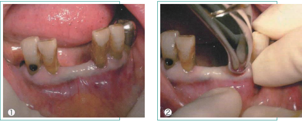 拔牙的细致流程详解