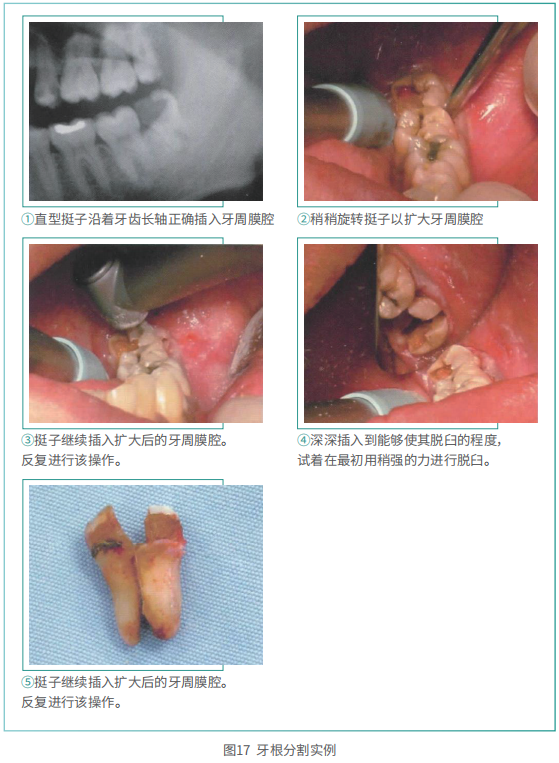 拔牙的细致流程详解