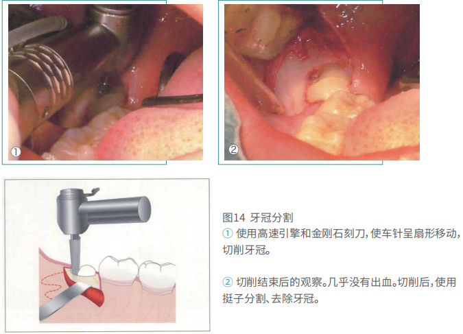 拔牙的细致流程详解