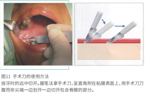 拔牙的细致流程详解