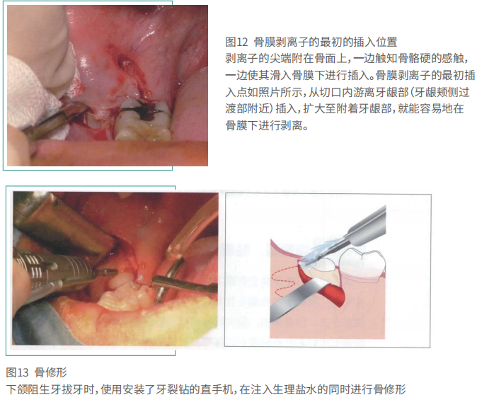 拔牙的细致流程详解