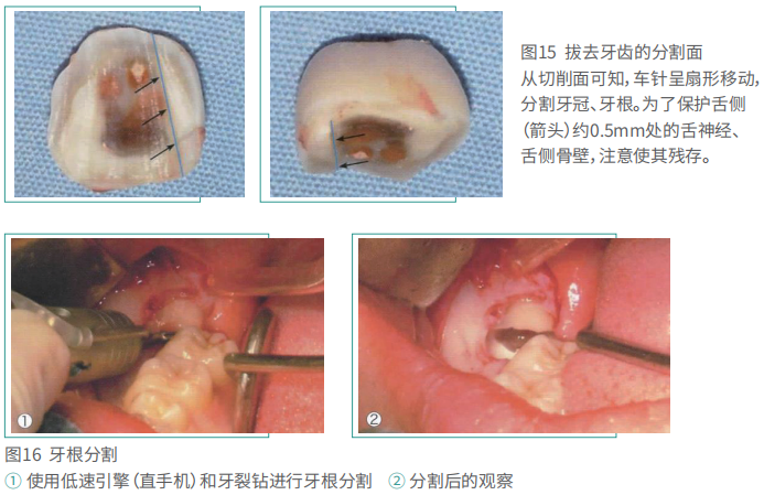 拔牙的细致流程详解