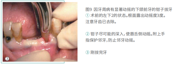 拔牙的细致流程详解