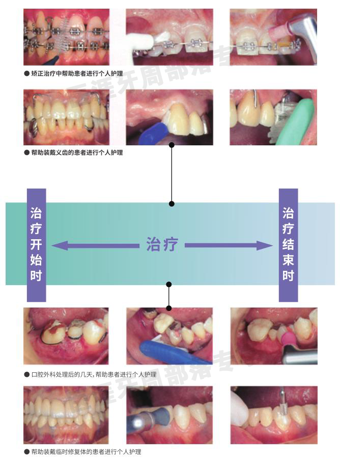 洁牙要哪些器材PMTC各种仪器、器材的选择_https://www.jmylbn.com_新闻资讯_第4张