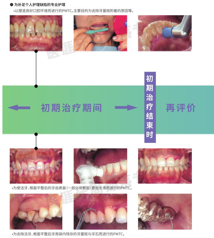 洁牙要哪些器材PMTC各种仪器、器材的选择_https://www.jmylbn.com_新闻资讯_第3张