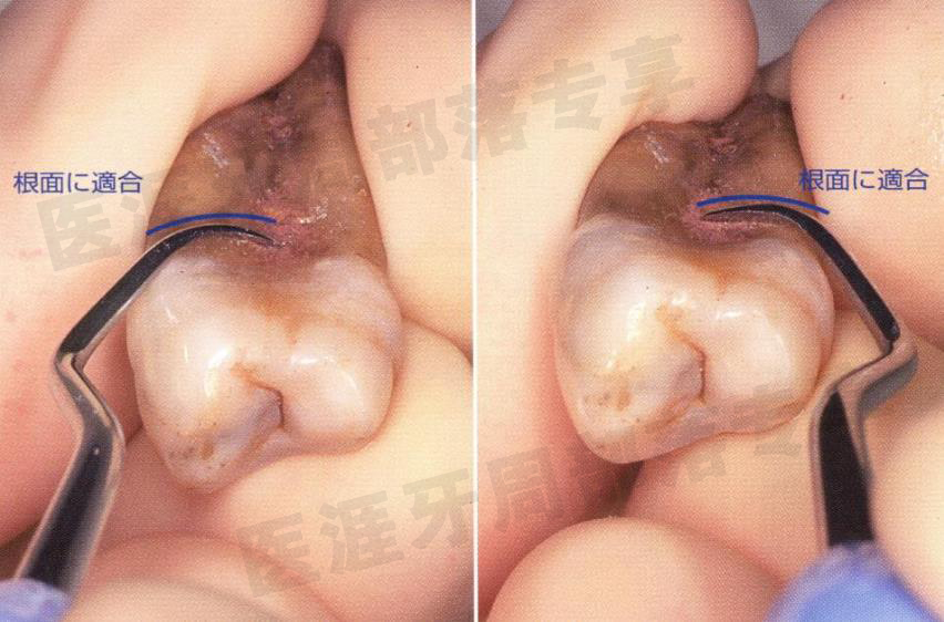 怎么选洁牙器械5个要点带你学习器械洁牙_https://www.jmylbn.com_新闻资讯_第34张