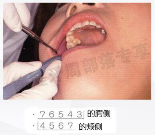 怎么选洁牙器械5个要点带你学习器械洁牙_https://www.jmylbn.com_新闻资讯_第15张