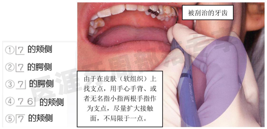 怎么选洁牙器械5个要点带你学习器械洁牙_https://www.jmylbn.com_新闻资讯_第17张