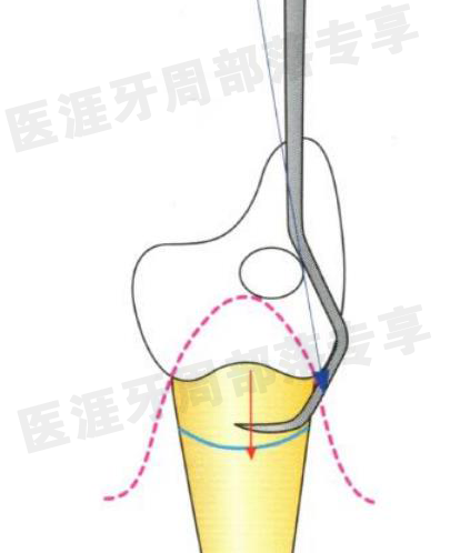 怎么选洁牙器械5个要点带你学习器械洁牙_https://www.jmylbn.com_新闻资讯_第26张