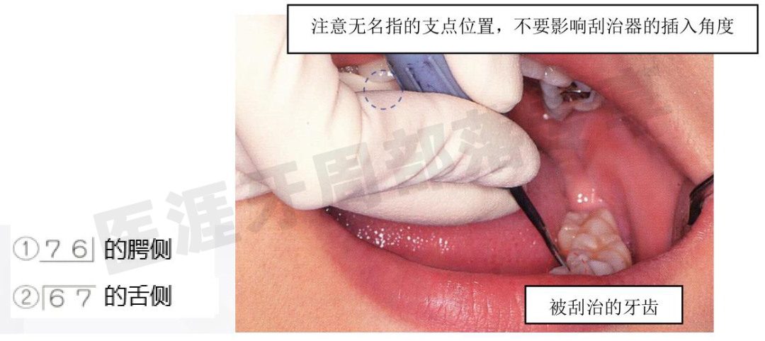 怎么选洁牙器械5个要点带你学习器械洁牙_https://www.jmylbn.com_新闻资讯_第19张