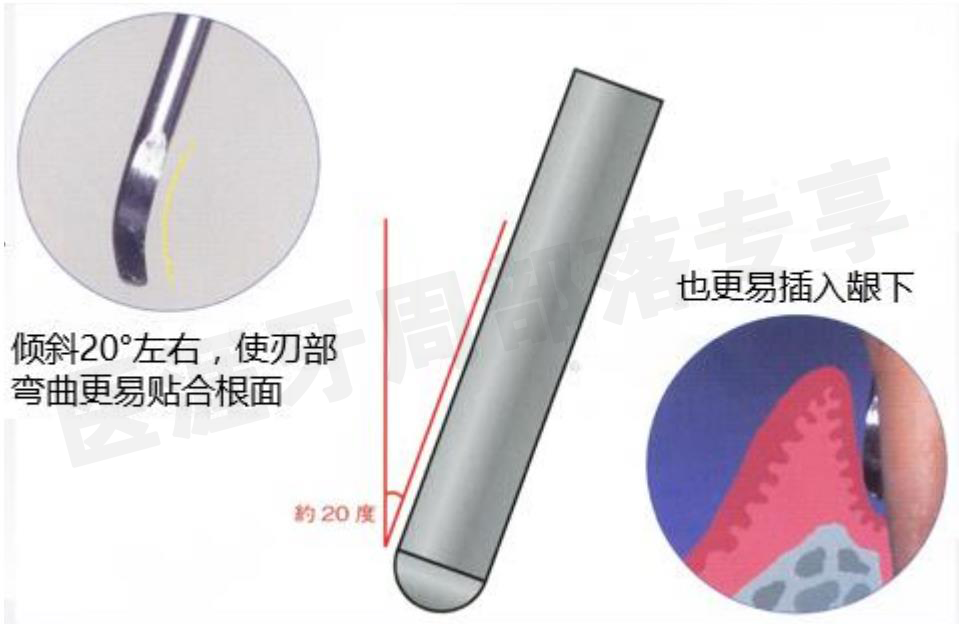 怎么选洁牙器械5个要点带你学习器械洁牙_https://www.jmylbn.com_新闻资讯_第2张