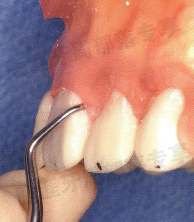 怎么选洁牙器械5个要点带你学习器械洁牙_https://www.jmylbn.com_新闻资讯_第23张