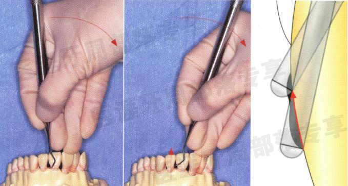 怎么选洁牙器械5个要点带你学习器械洁牙_https://www.jmylbn.com_新闻资讯_第32张