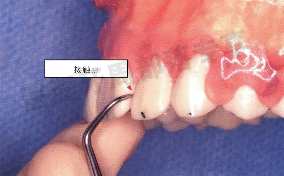怎么选洁牙器械5个要点带你学习器械洁牙_https://www.jmylbn.com_新闻资讯_第20张
