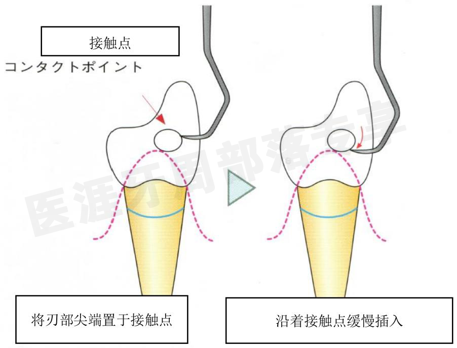 怎么选洁牙器械5个要点带你学习器械洁牙_https://www.jmylbn.com_新闻资讯_第21张