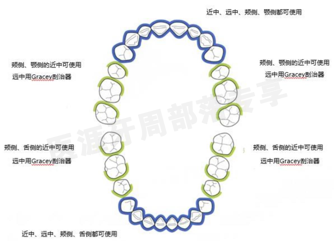 怎么选洁牙器械5个要点带你学习器械洁牙_https://www.jmylbn.com_新闻资讯_第8张